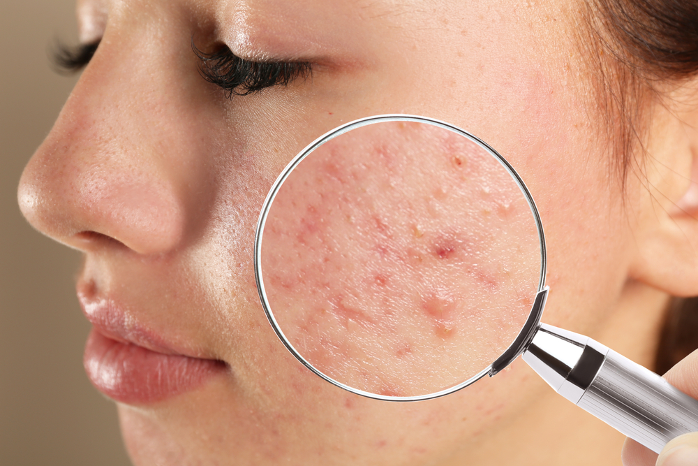 Acne and Acne Scarring Treatments